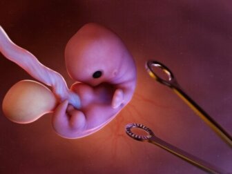O que é o aborto induzido?