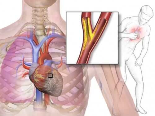 Angina de peito