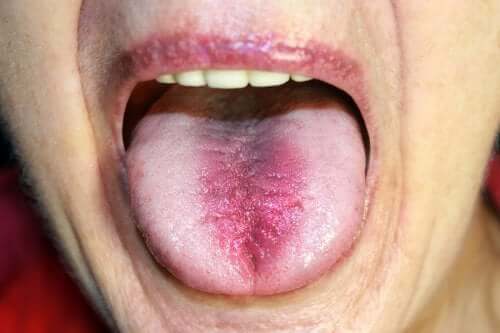 Síndrome da ardência bucal