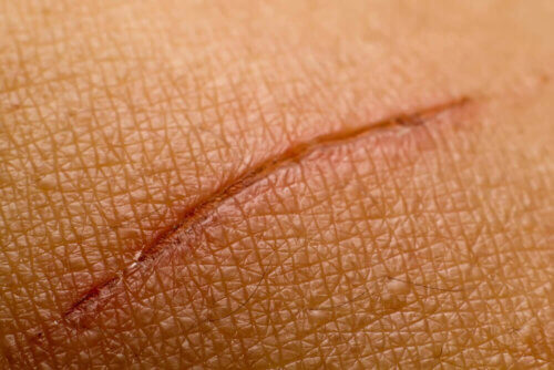 Cicatrizes na pele