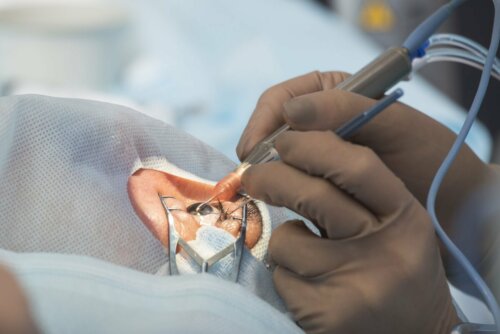 Cirurgia ocular