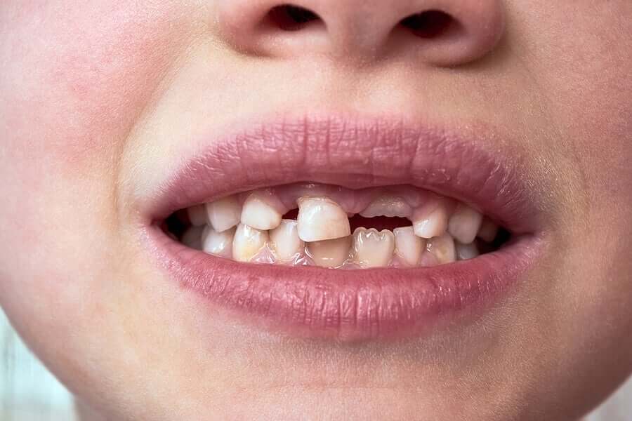 Dentes de leite das crianças