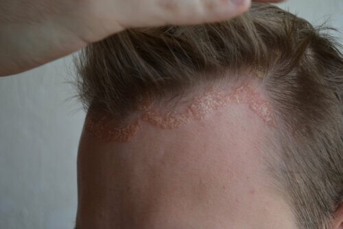 Dermatite de couro cabeludo
