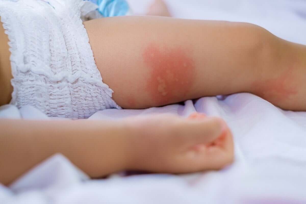 Criança com alergia na pele