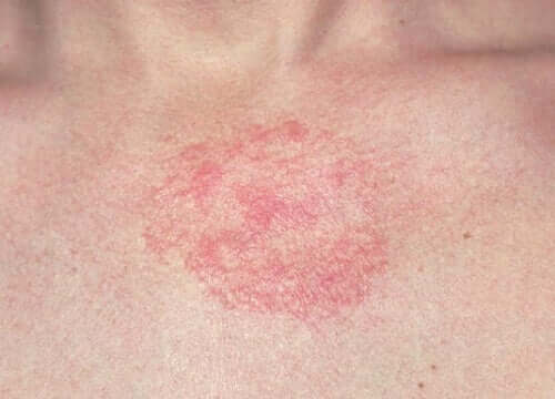 Irritação da pele