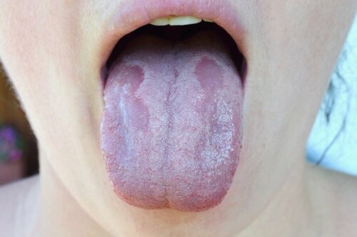 Infecção na língua