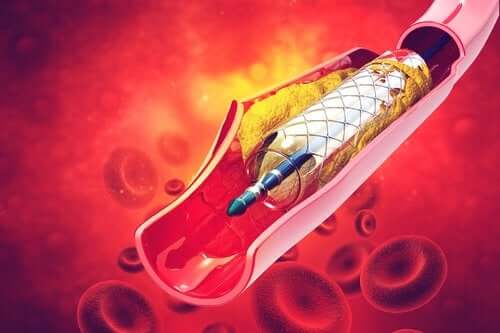 O que é um stent e para que serve?