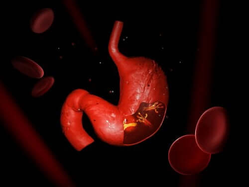 Síndrome de dumping