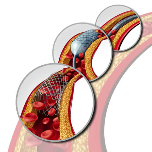 Stent nas artérias