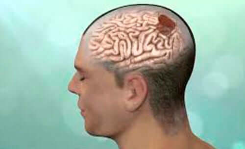 epilepsia gelástica