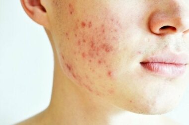 Características da acne cística