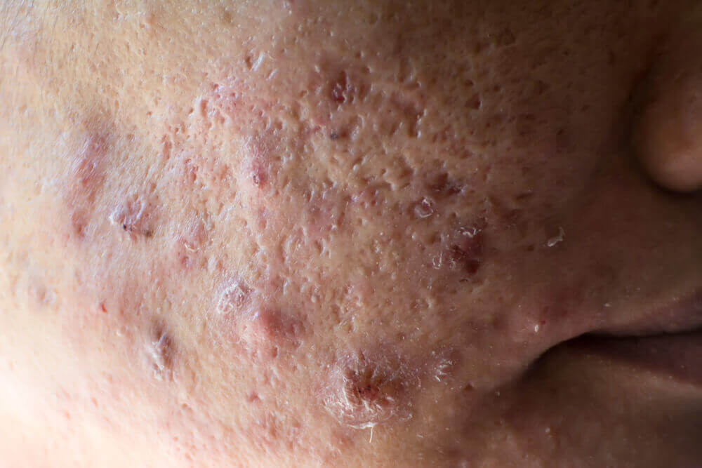 Pessoa com acne cística