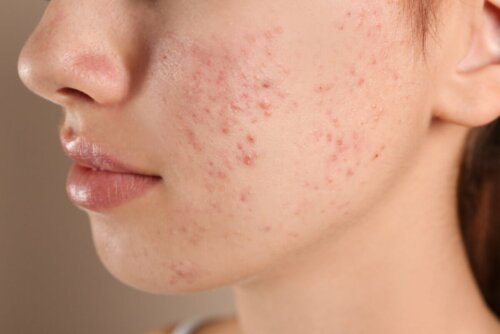 Acne no rosto