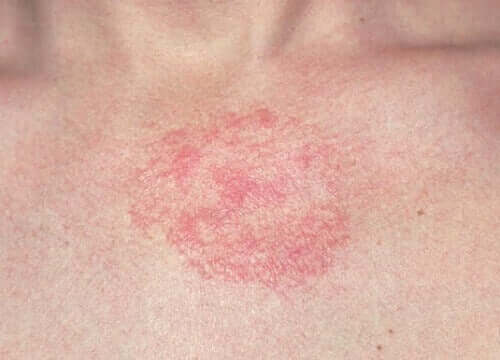 A actinodermatose pode ser prevenida com o uso de protetor solar