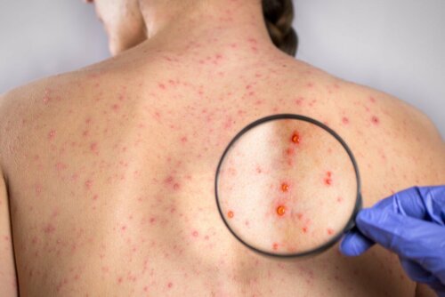 Lesões causadas pela rubéola