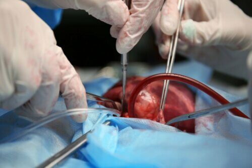 Cirurgia de coração aberto
