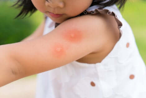 As crianças são sensíveis às picadas de insetos