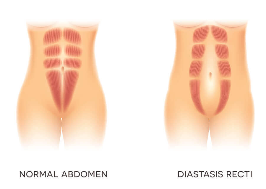 Abdômen normal e com diástase