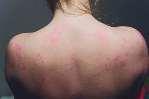 O que é a actinodermatose?