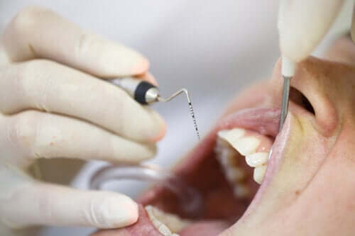 Piorreia ou periodontite: o que é e como tratar?