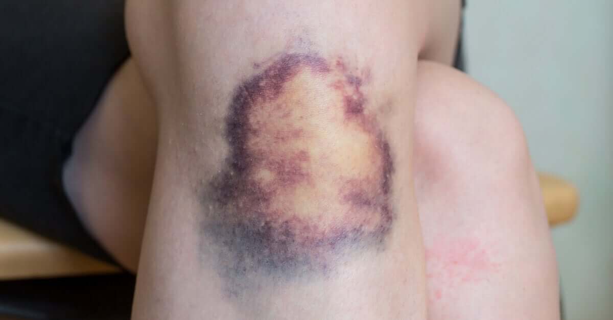 Hematoma no joelho