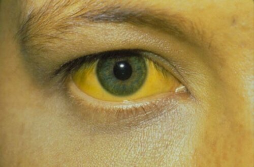 Olhos amarelados