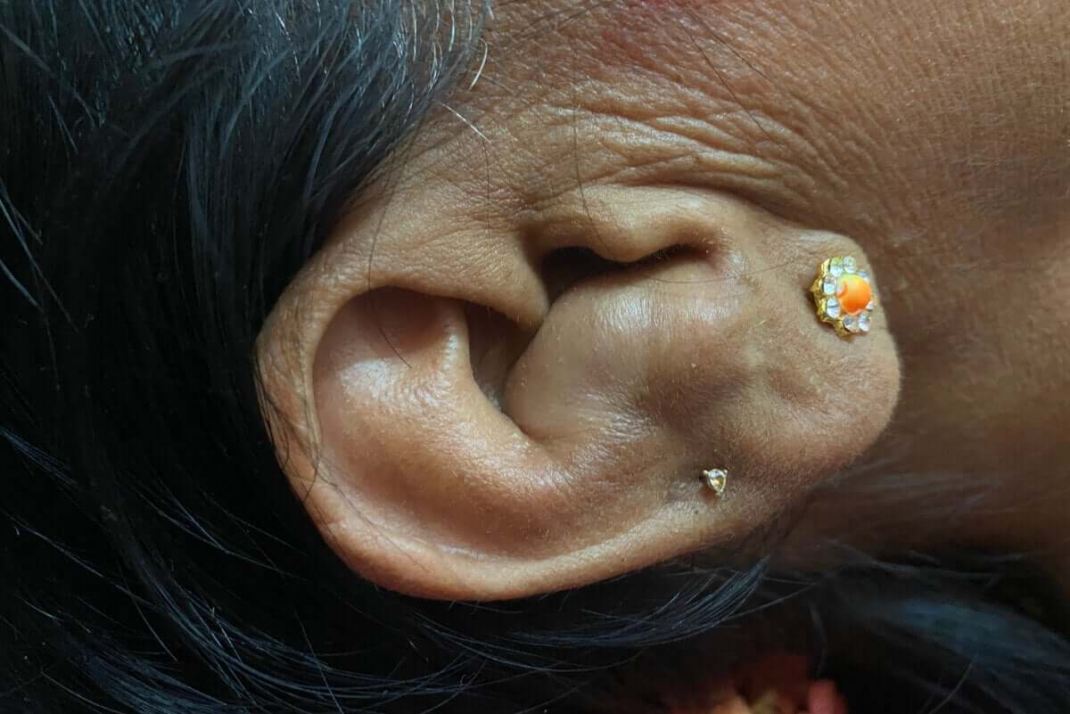 Mulher com orelha de couve-flor