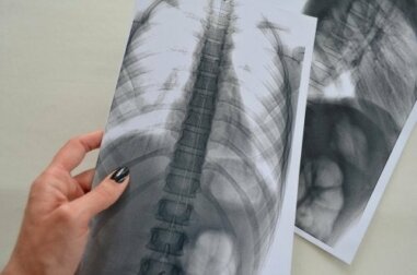Radiografia da lombar: devo me preocupar?