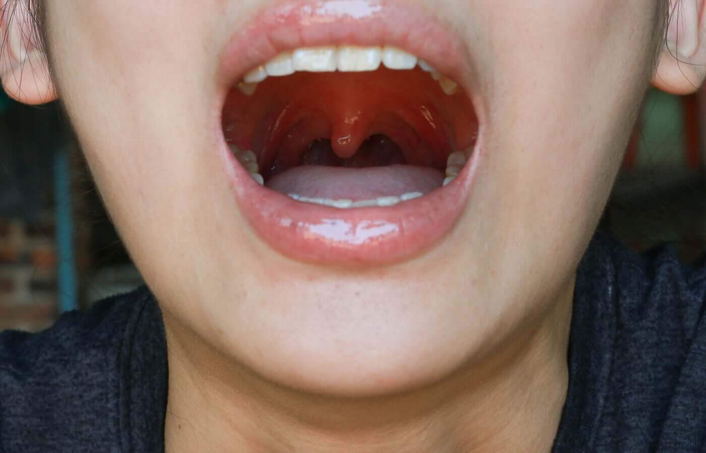 Inflamação na garganta