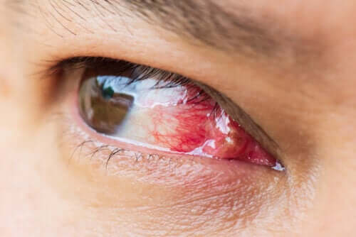 Carne crescida nos olhos: o que é e por que aparece?