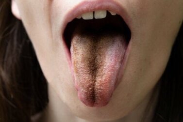 Língua negra pilosa: causas, sintomas e orientações