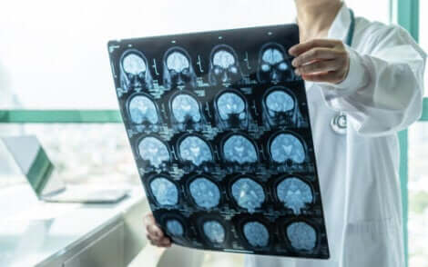 O diagnóstico precoce da encefalite pode salvar vidas