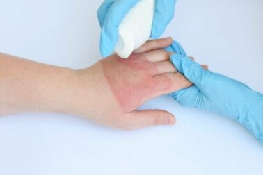 Queimaduras com vapor e água quente: tratamentos e recomendações