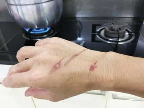 As queimaduras com vapor são comuns quando cozinhamos