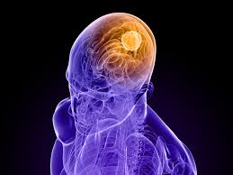 Origem e características do glioma