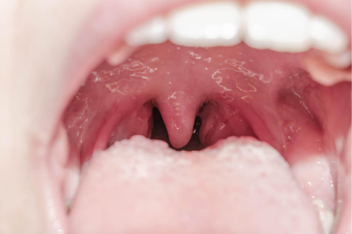 Tratamento da uvulite