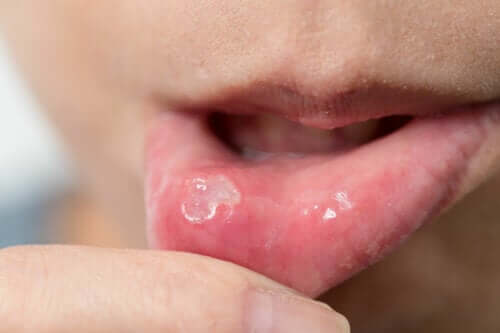 Quais são as causas das aftas na boca?