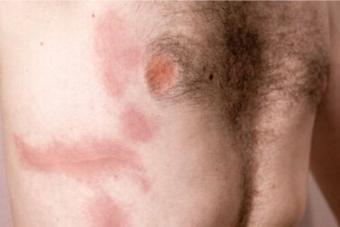 Contusão de costela: causas, sintomas e cuidados