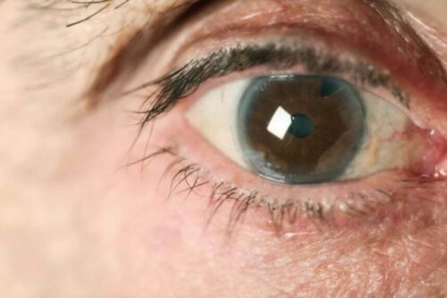 Olho com um dos tipos de glaucoma