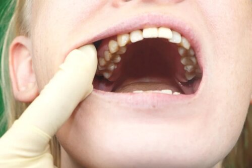 Dentes deteriorados