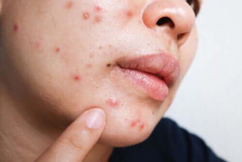 Isotretinoína para a acne: benefícios e efeitos colaterais