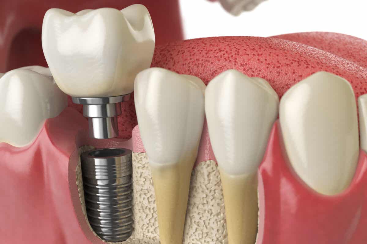 Tipos de próteses sobre implantes dentários e seus benefícios