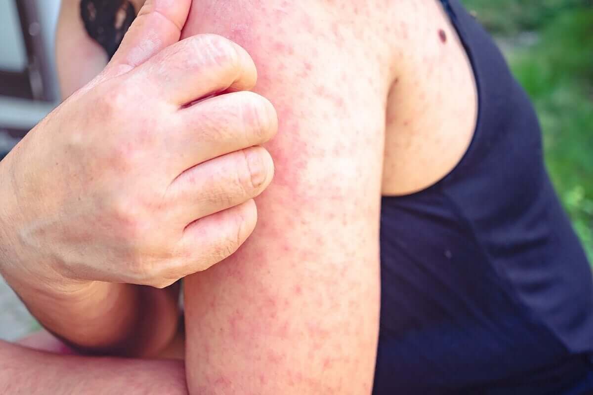 Alergia no braço