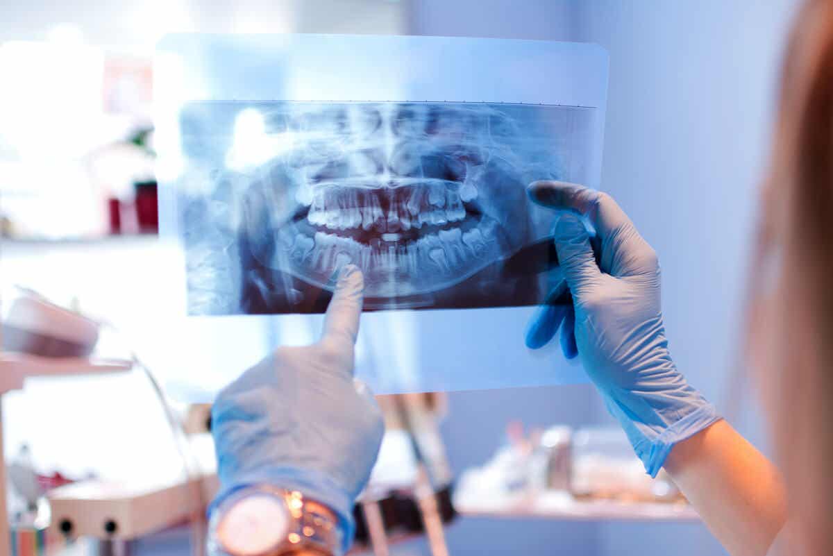 Radiografia dos dentes