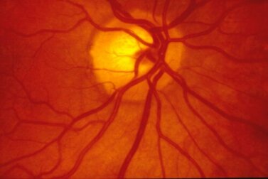 Cirurgia de flambagem escleral: como é realizada e para que serve?