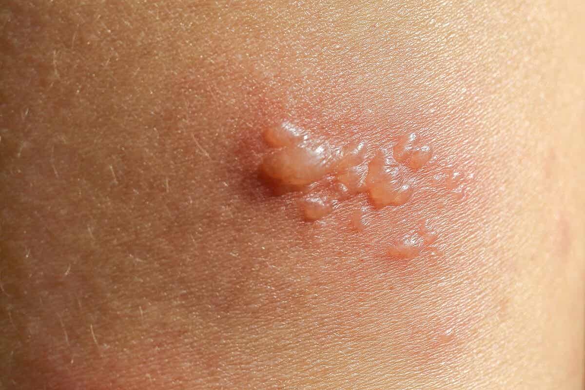 Penfigoide bolhoso