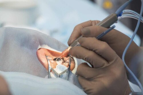 Cirurgia ocular