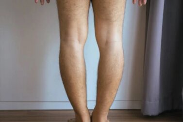 Geno varo ou pernas arqueadas: causas e tratamento