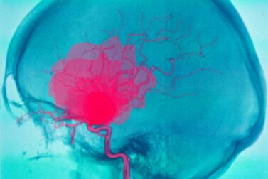 O que é uma hemorragia cerebral e por que pode ocorrer?