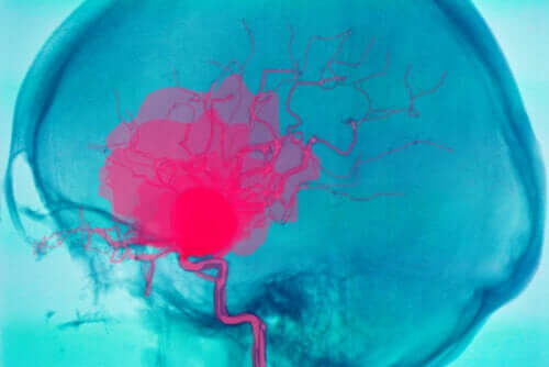 O que é uma hemorragia cerebral e por que pode ocorrer?